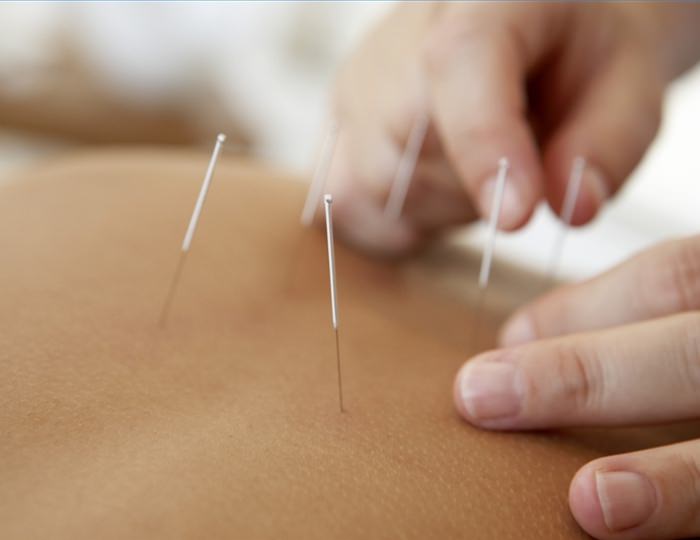 Иглорефлексотерапия - Санаторий «им. Тельмана»